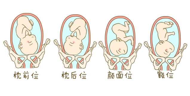 胎位roa是什么意思