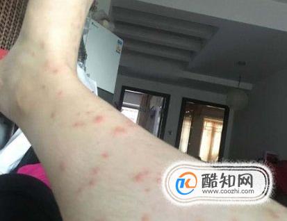 螨虫咬的包是啥样子，被螨虫咬的症状图片