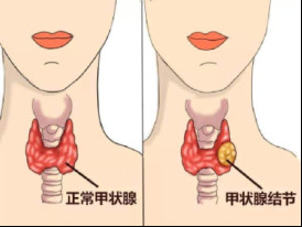 甲状腺的主要症状